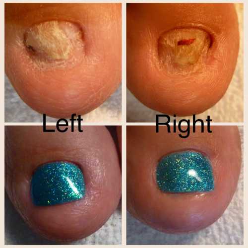 Corrective Toenail Reconstruction July 2016